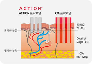 부산 어붐야그 표피 박피 과정