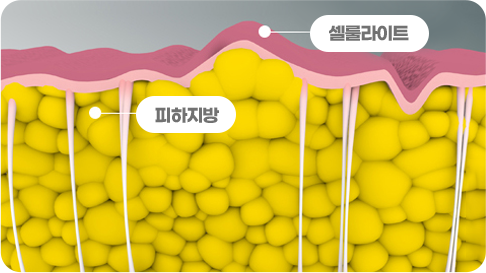 부산 트리플바디 시술 전 지방 축적 상태